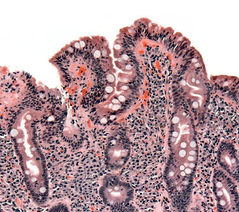 Predisposing Causes for the Development of SIBO